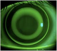 Corneal Refractive therapy