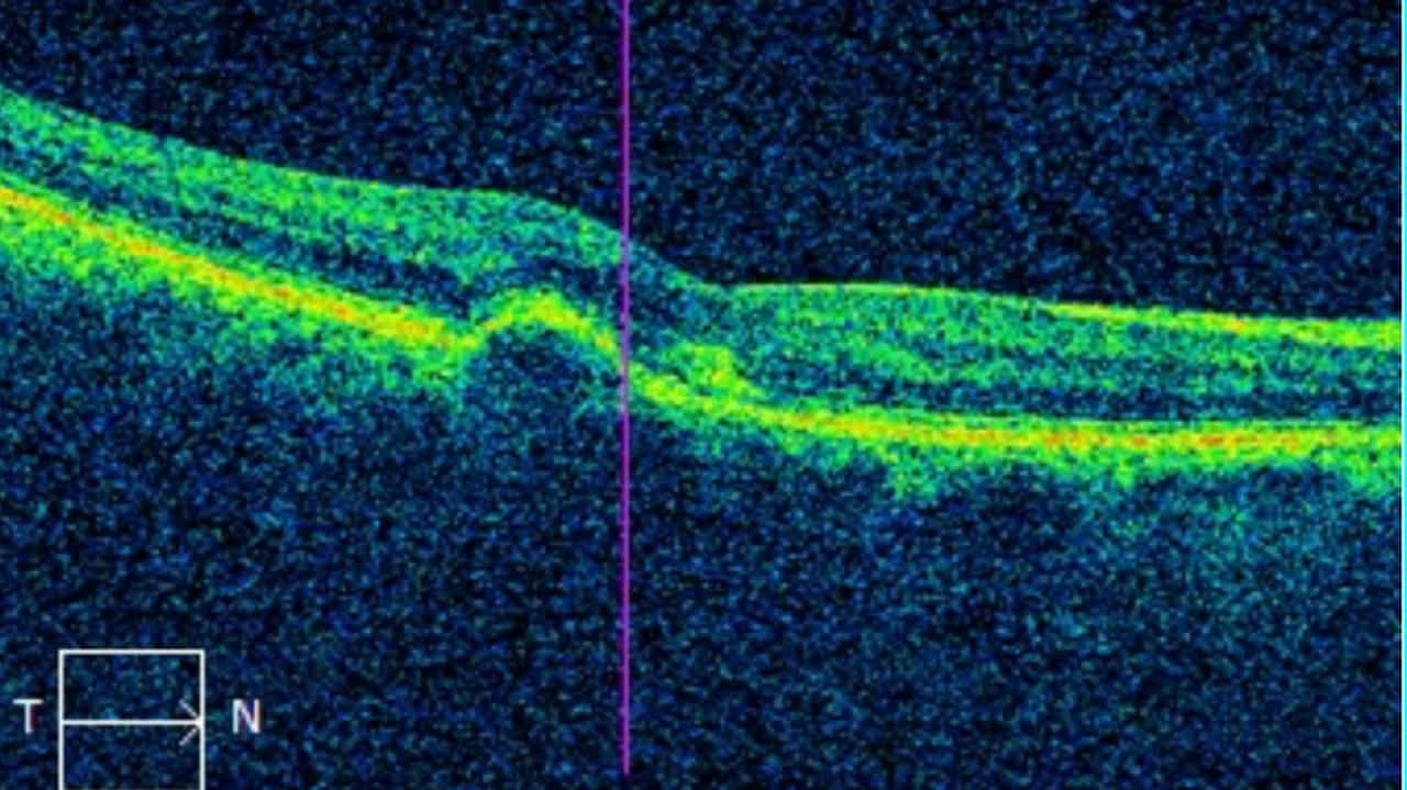 Macular Degeneration